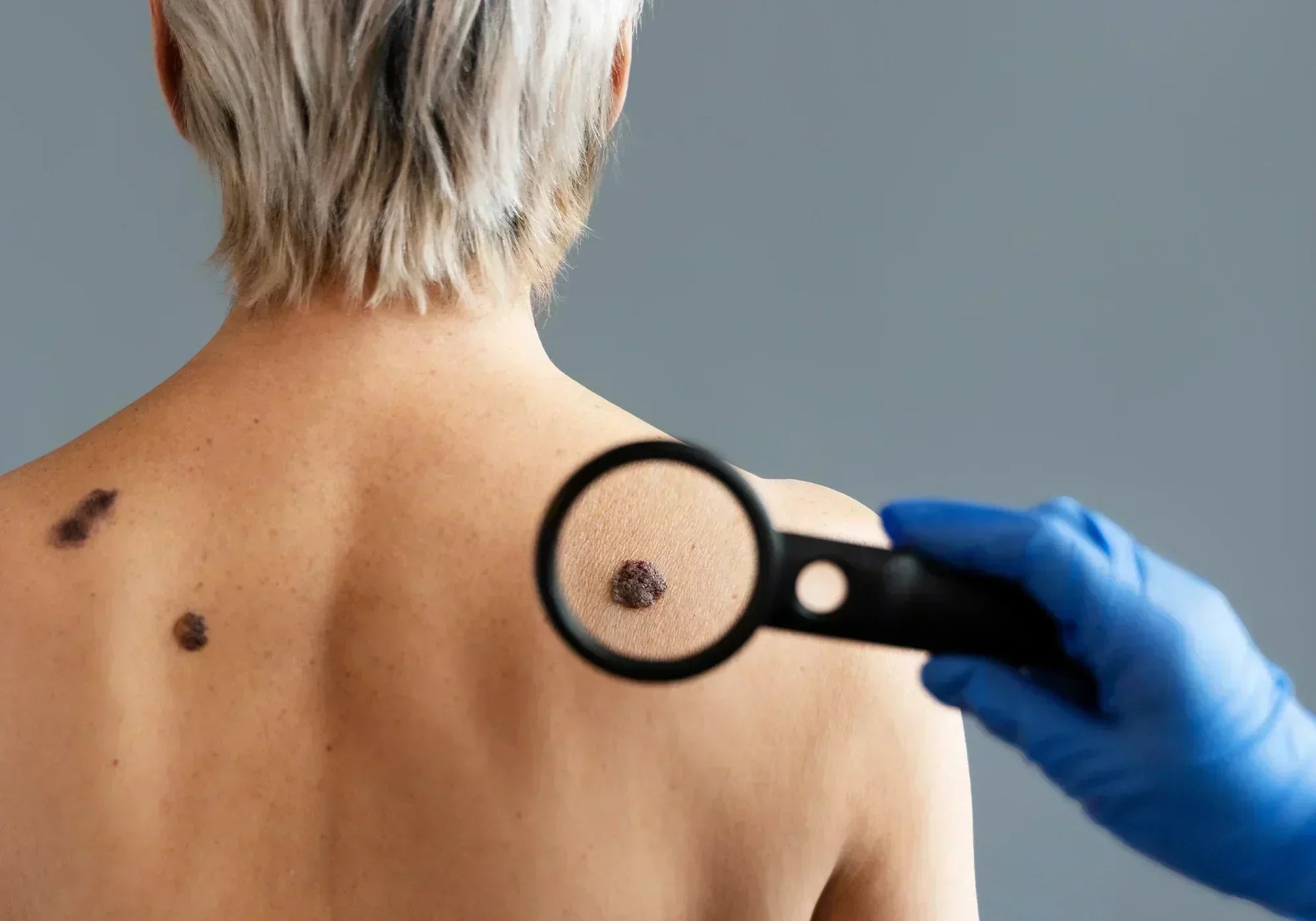 Лекува ли котешката стъпка брадавици?